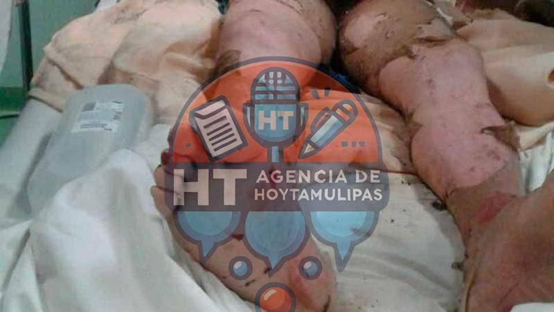 Quemaduras Quemaduras