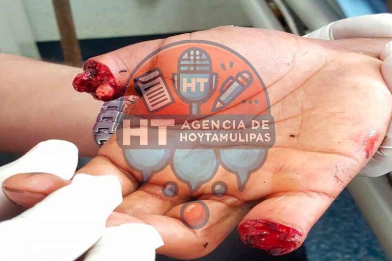 Amputan dedos Amputan dedos